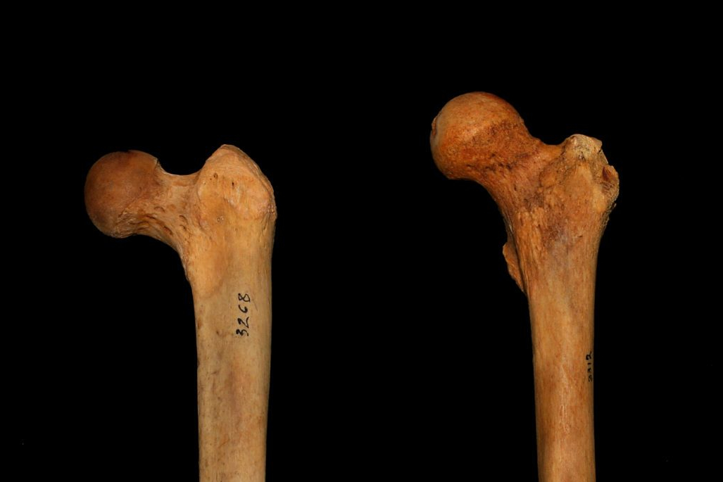 Femur_Inclination-e1506904732618