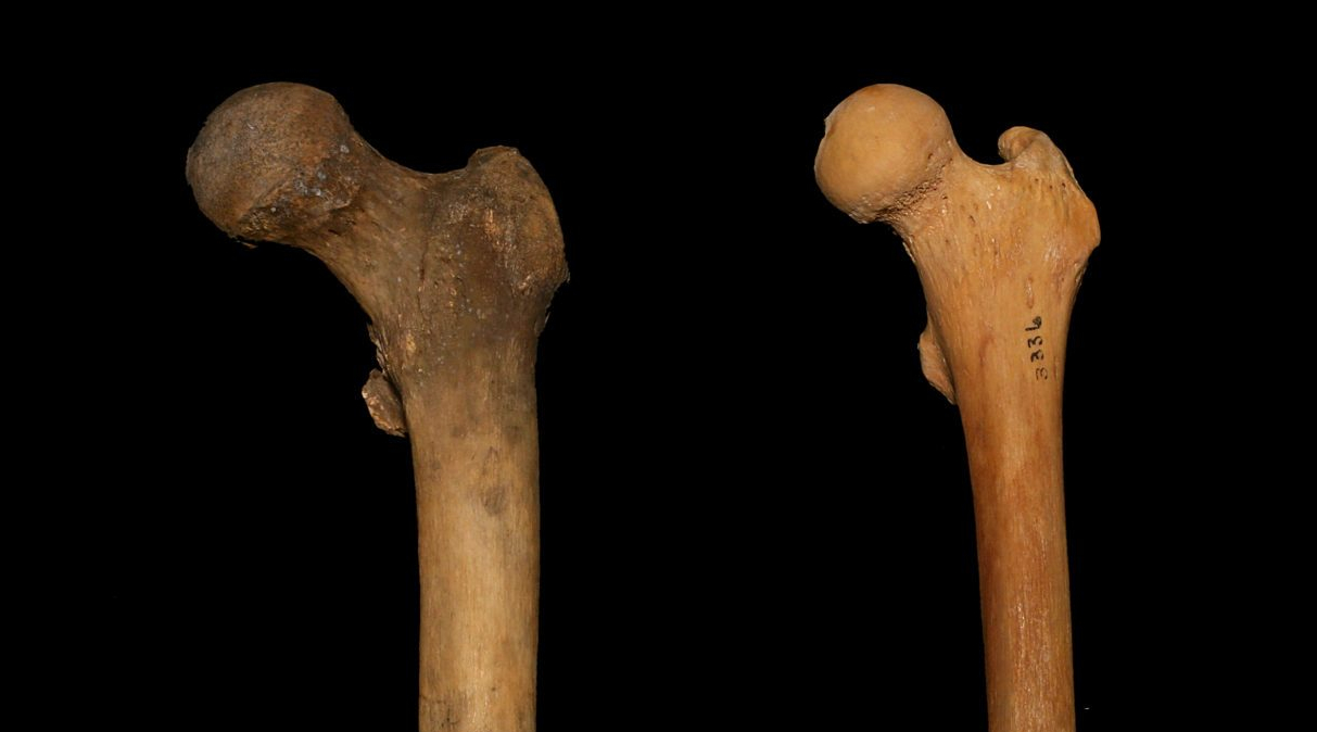 Femur_Neck_Length-e1506903738892