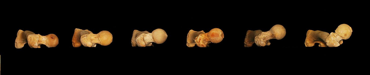 Femur_Torsion_3-e1506903704211