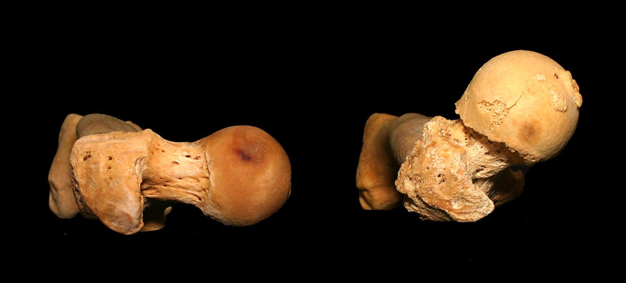 Femur_Torsion_4-e1506903679340